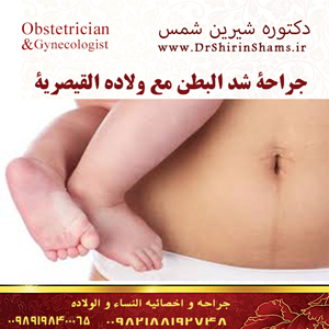 جراحة شد البطن مع ولاده القيصرية