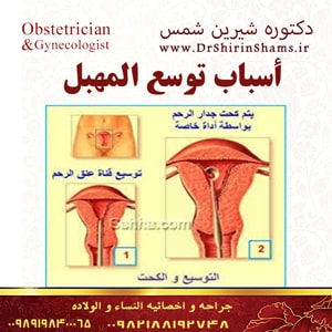 أسباب توسع المهبل